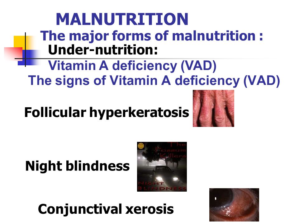 vad är malnutrition